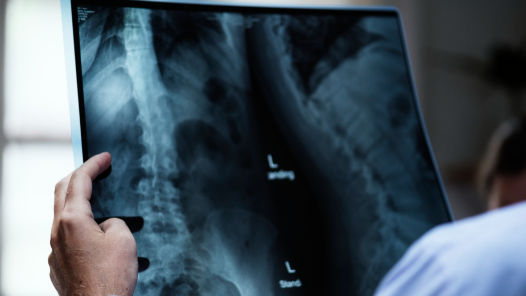 Spinal Surgery Claims – Naas & Dublin